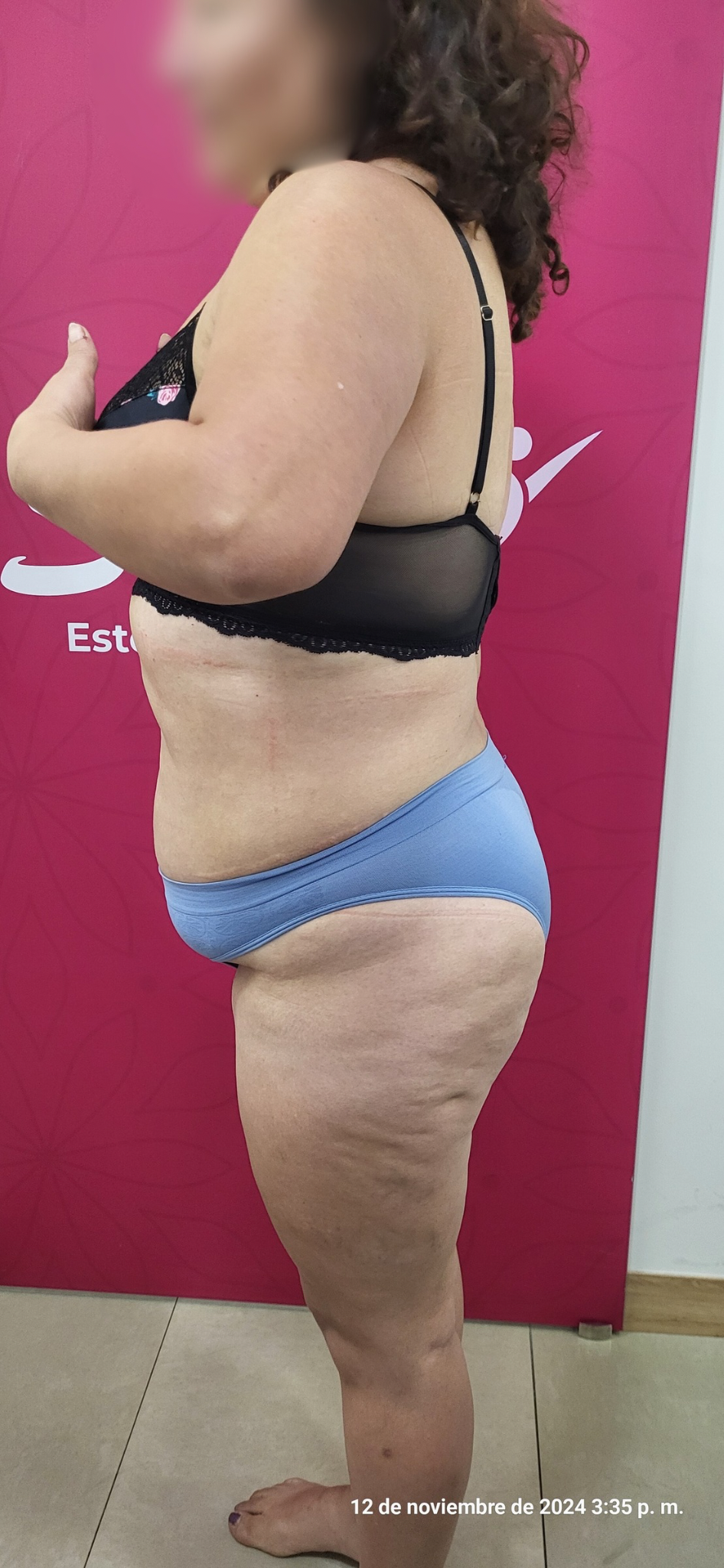 Después del tratamiento Vacunas Antiobesidad