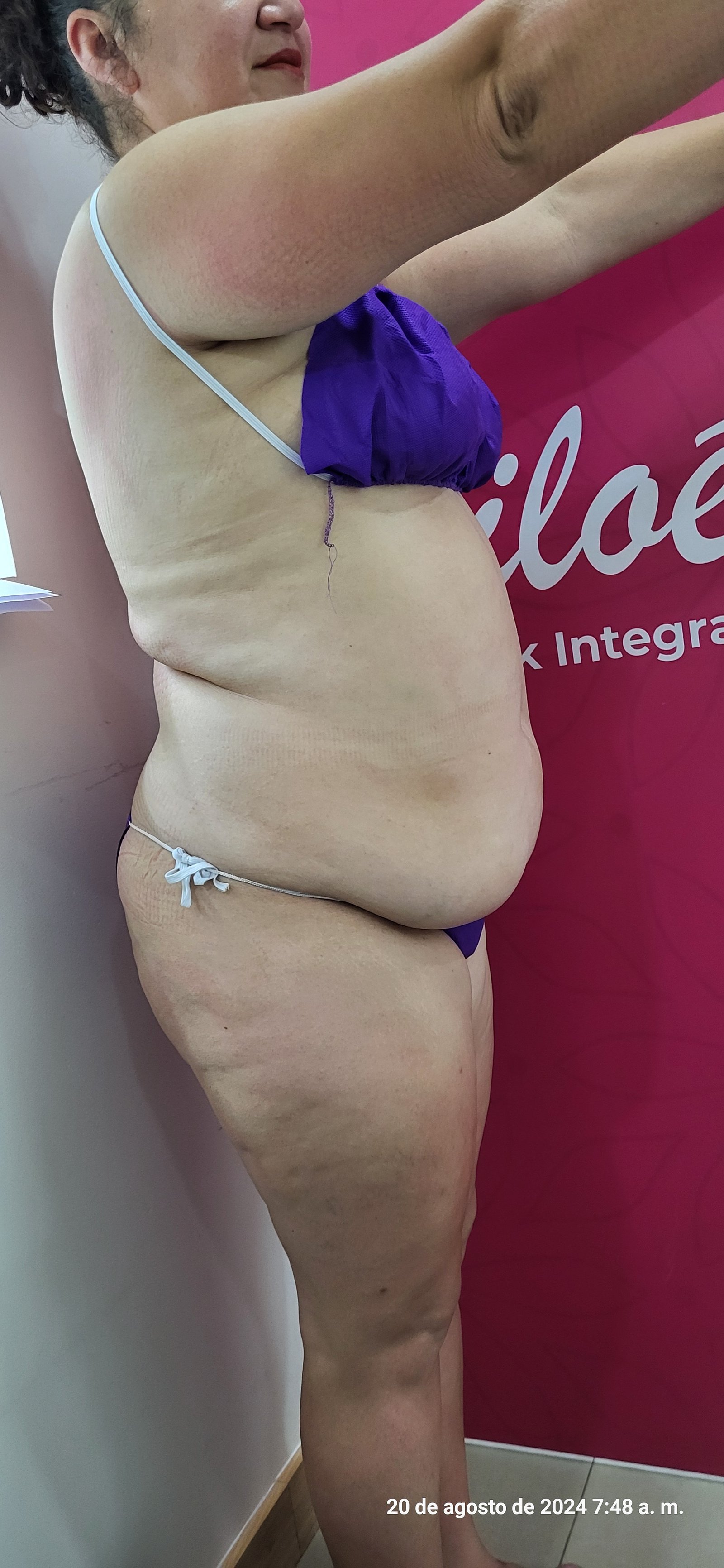 Antes del tratamiento Vacunas Antiobesidad