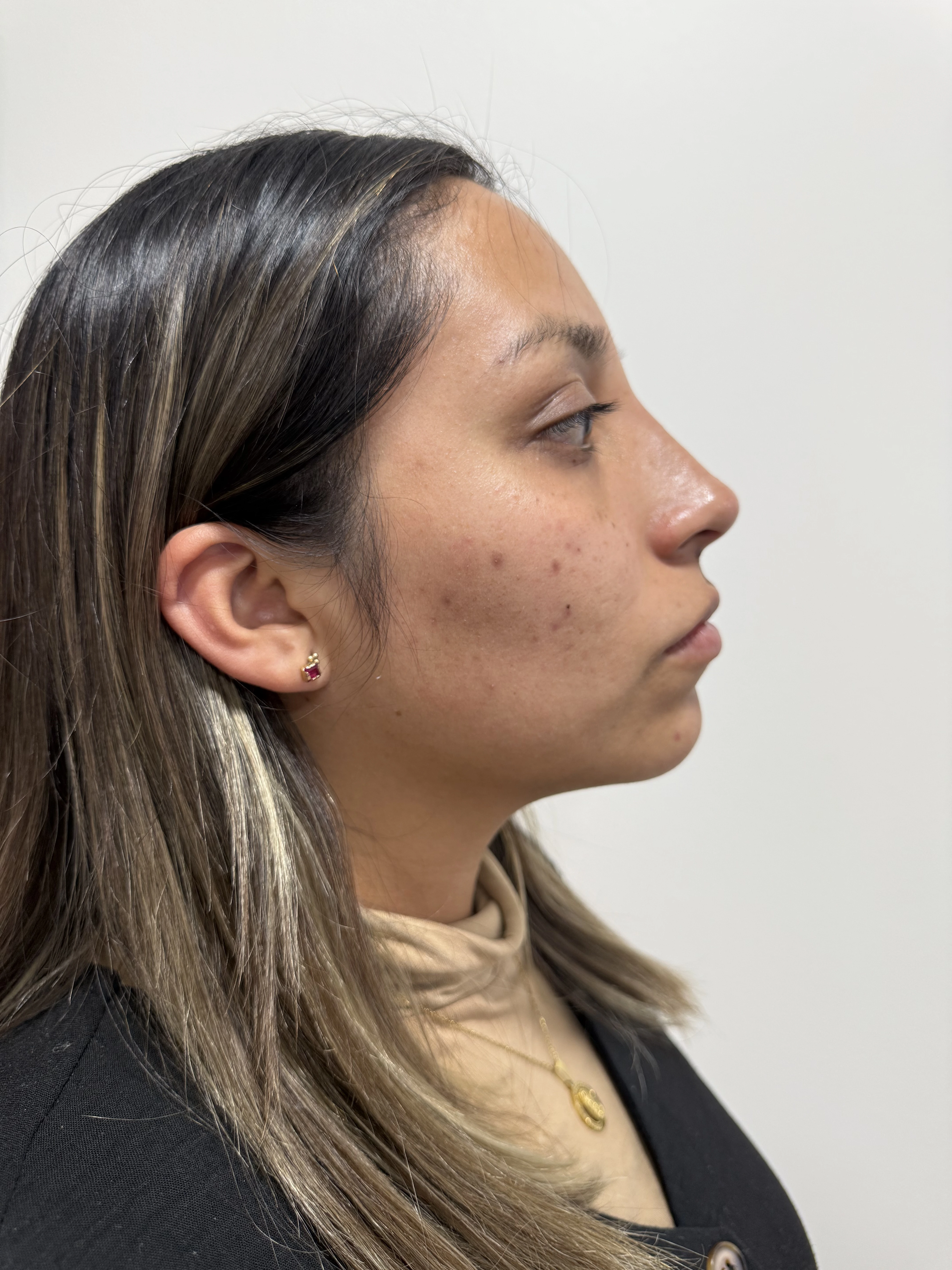 Después del tratamiento de ácido hialurónico