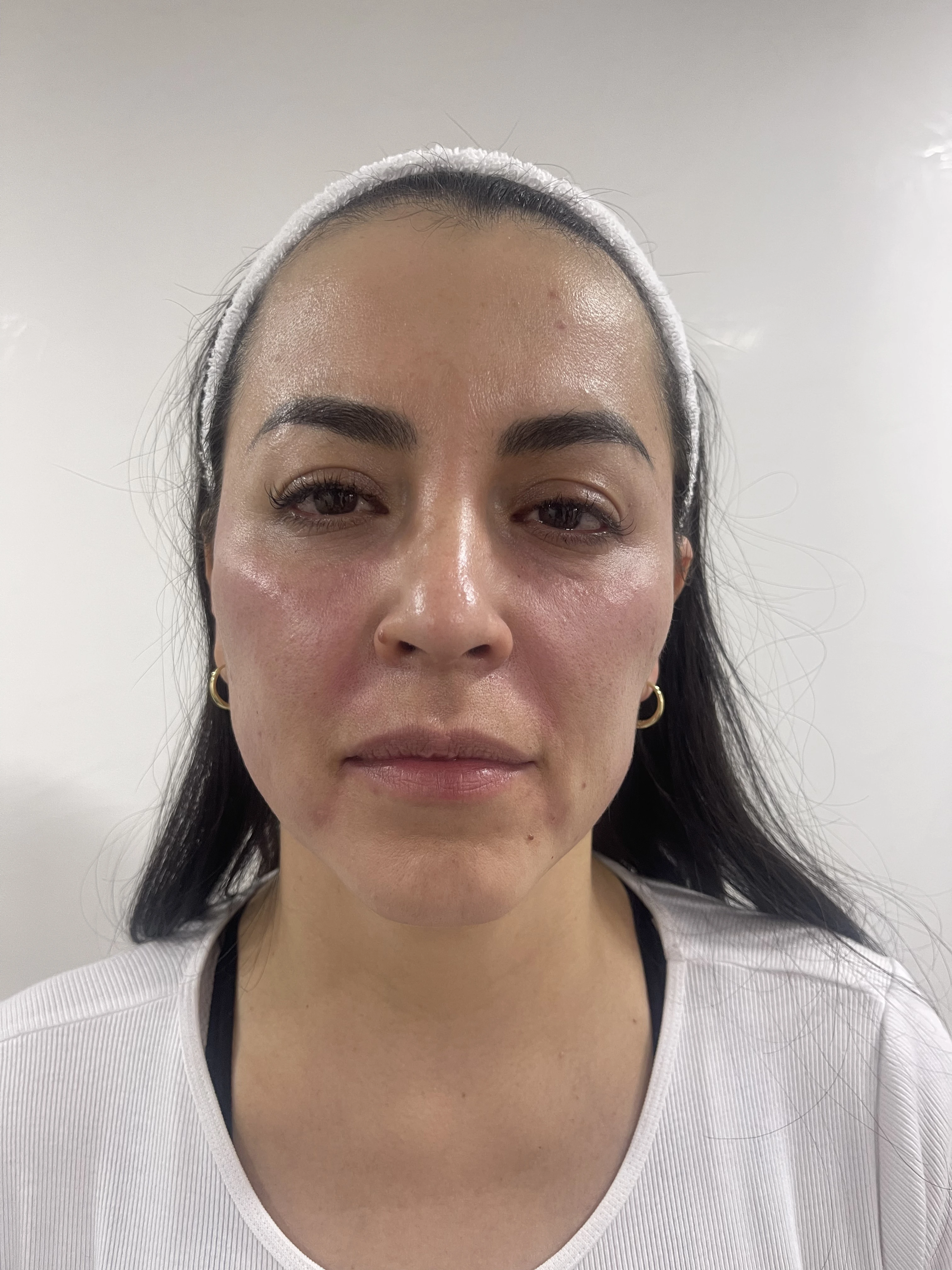 Después del tratamiento de bioestimuladores