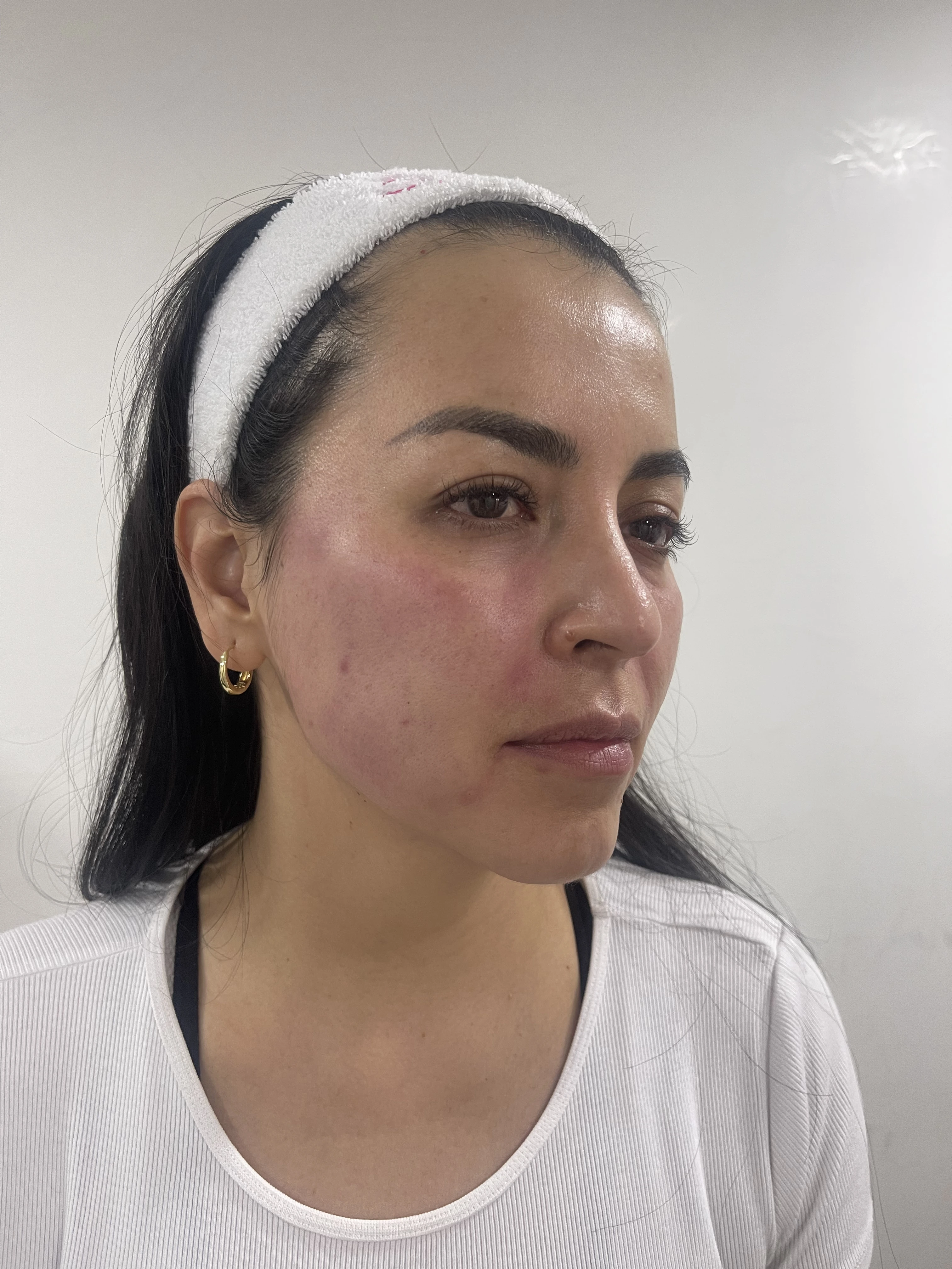 Después del tratamiento de bioestimuladores