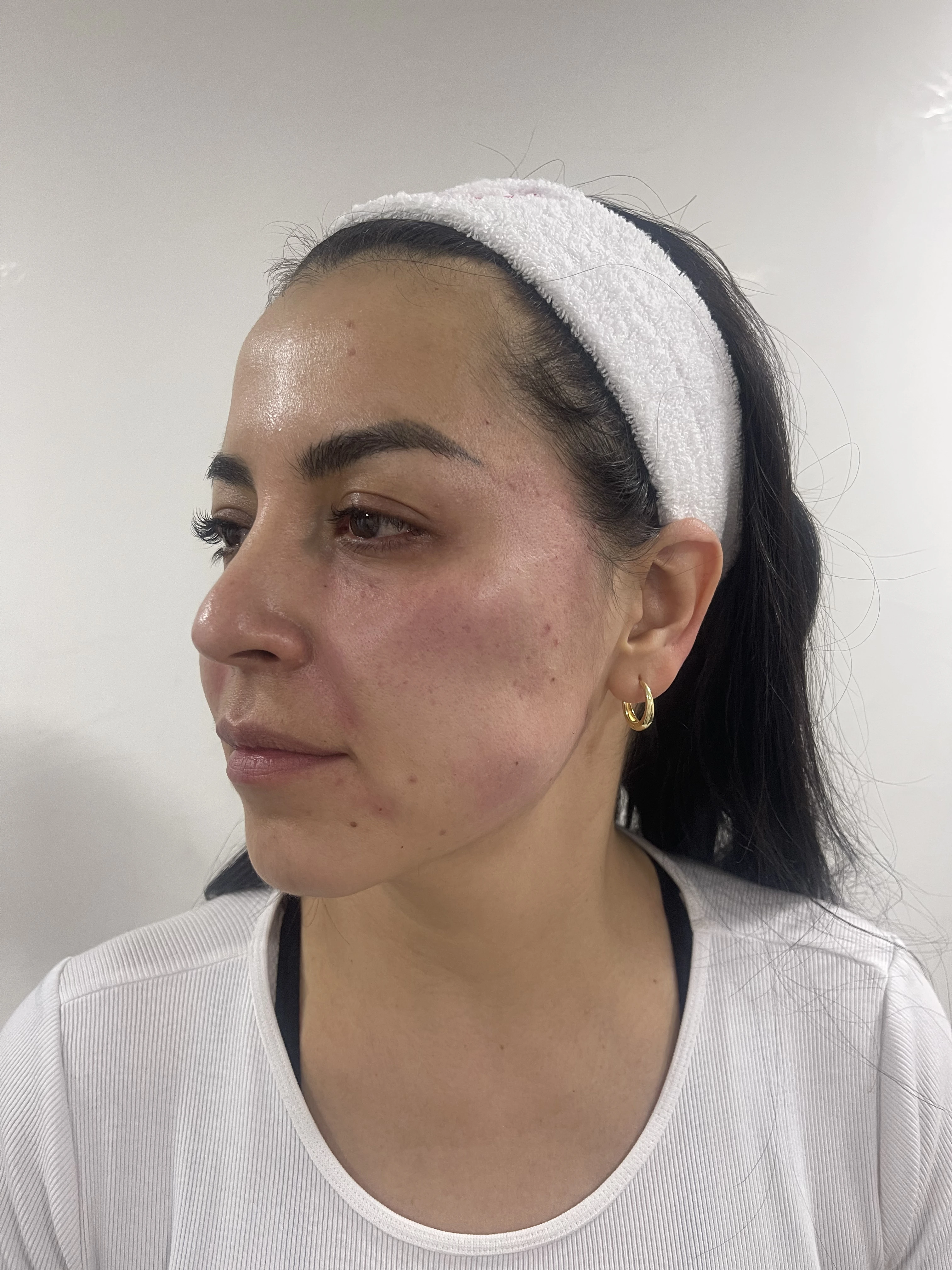 Después del tratamiento de bioestimuladores