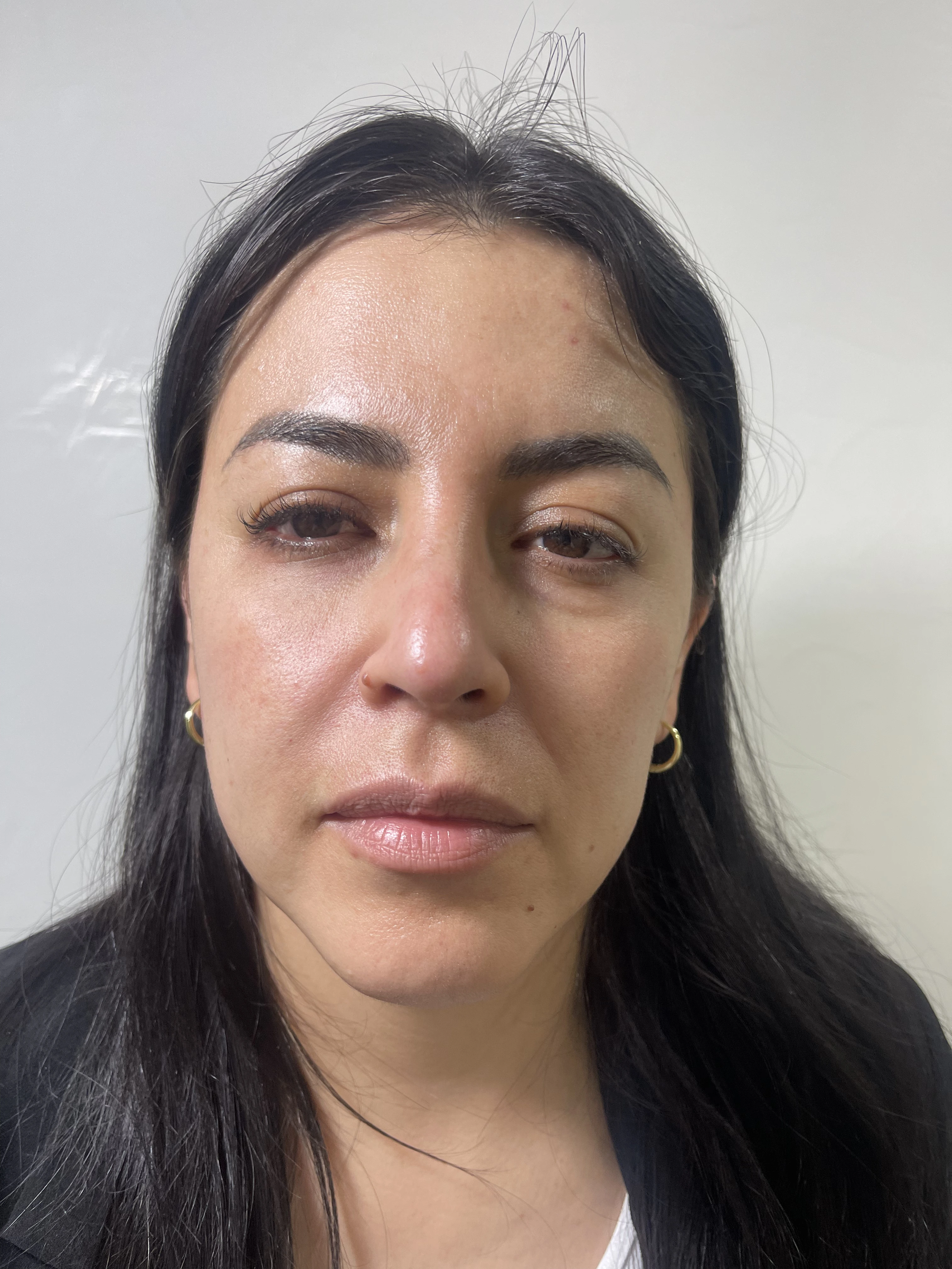 Antes del tratamiento de bioestimuladores