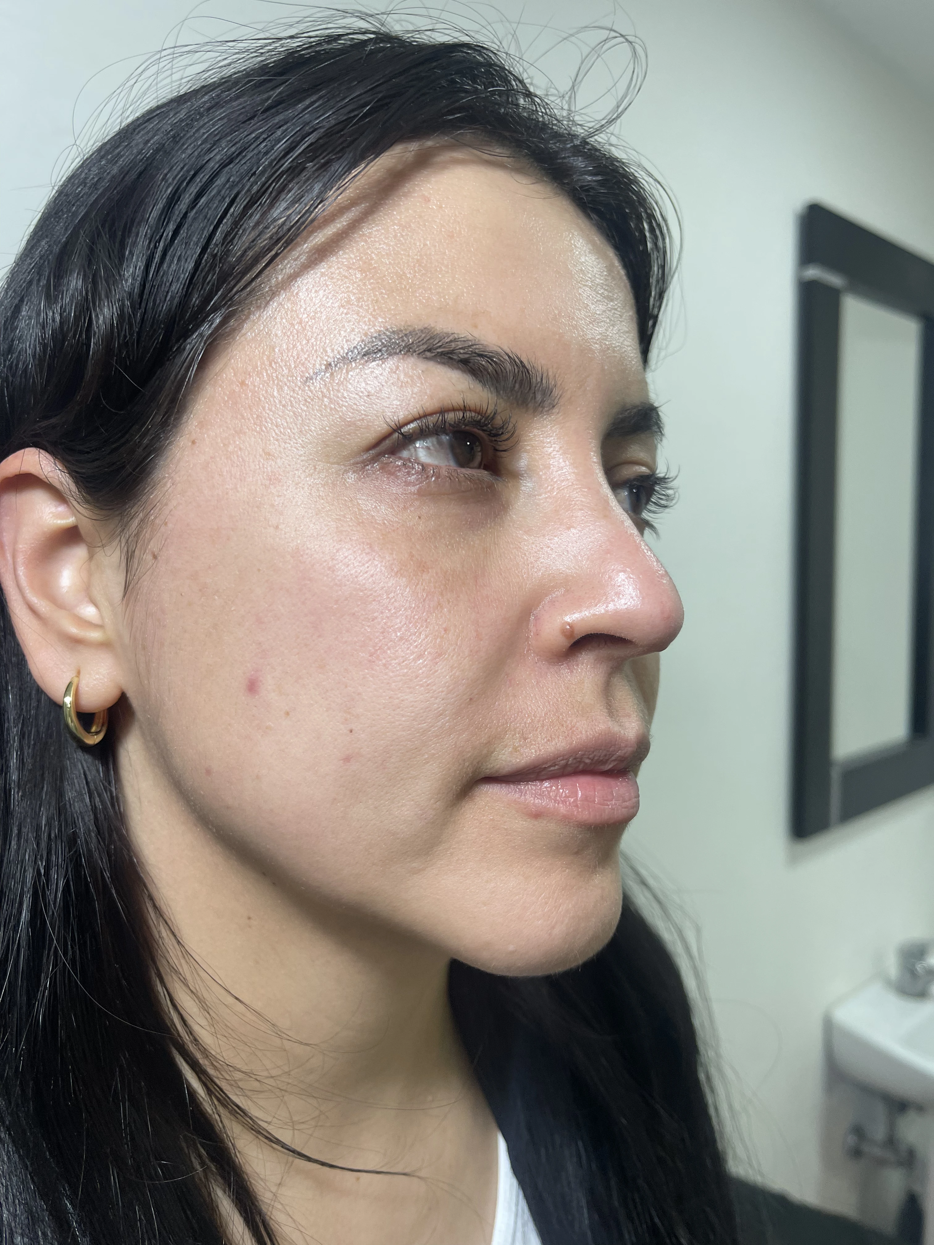 Antes del tratamiento de bioestimuladores