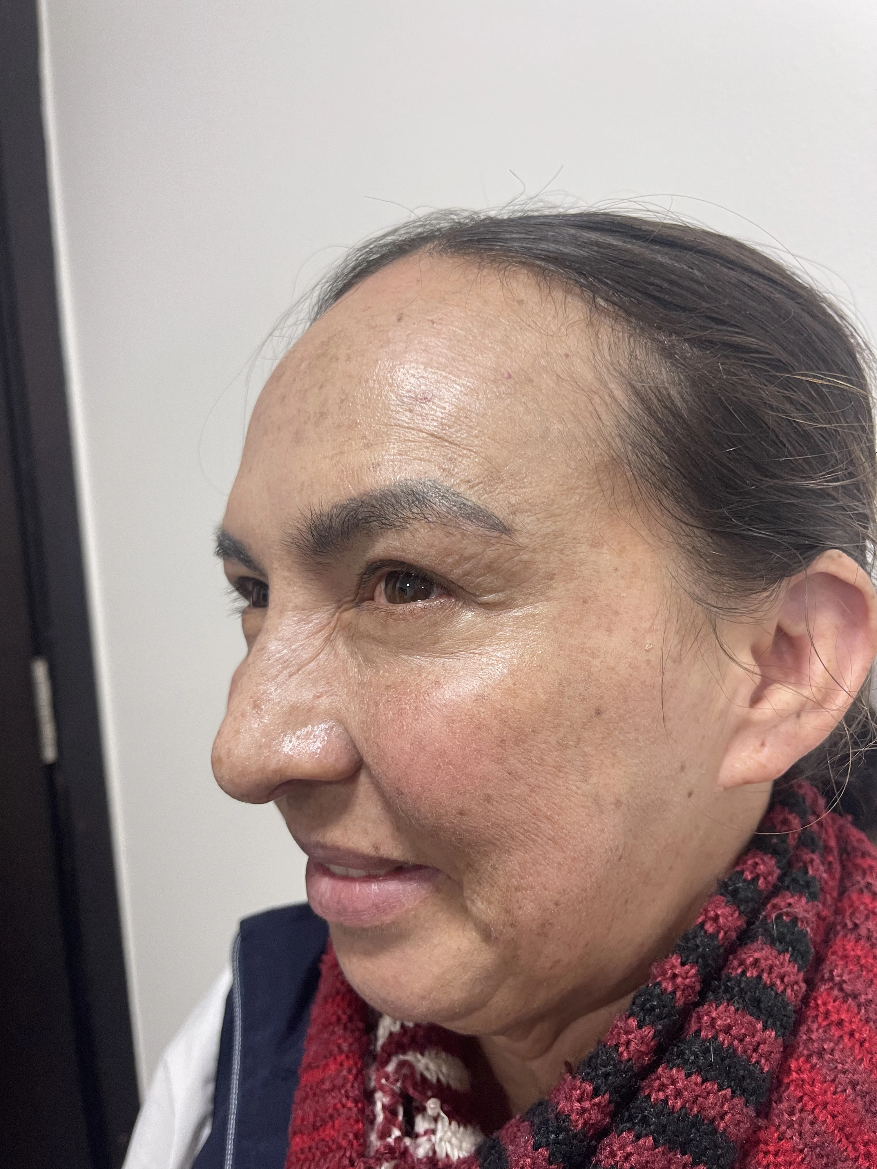 Después del tratamiento de Botox