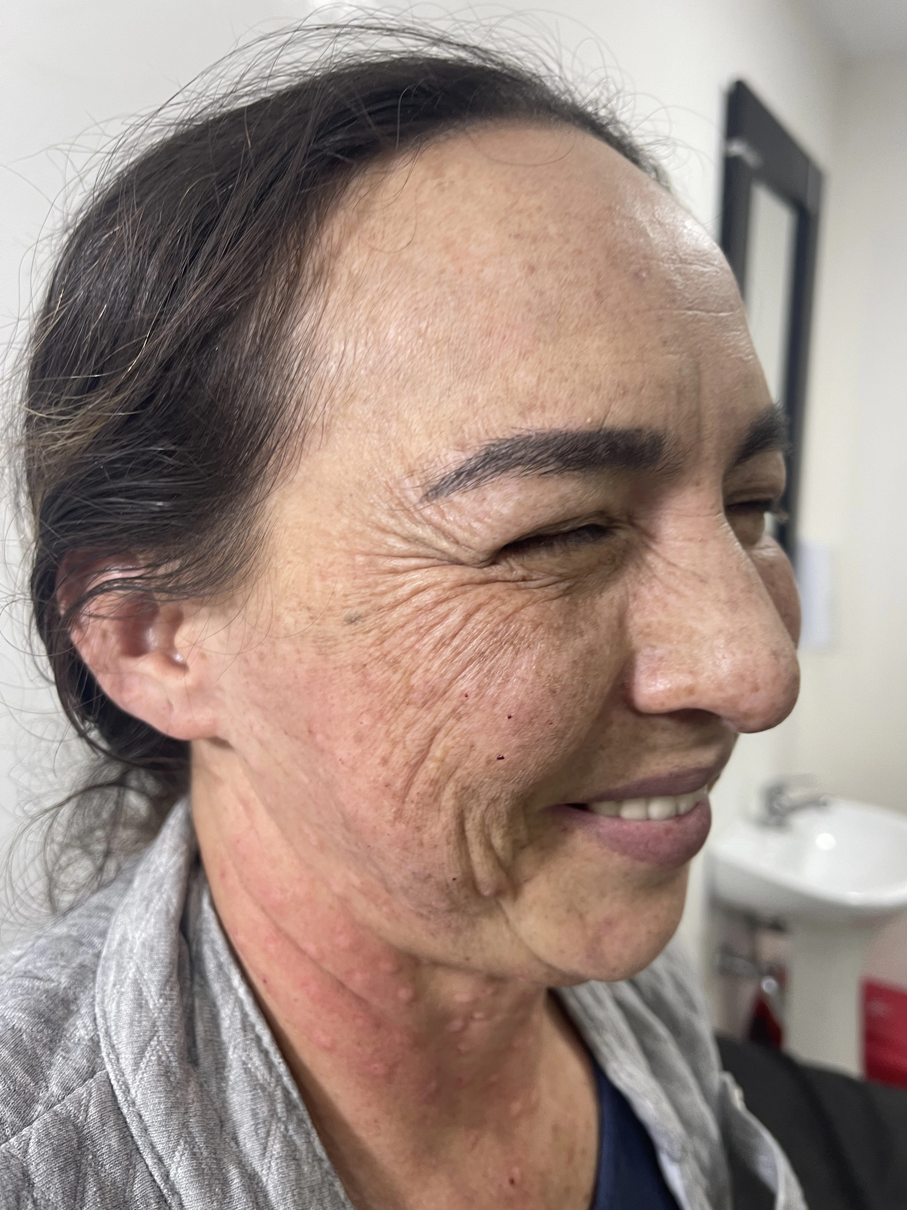 Antes del tratamiento de Botox