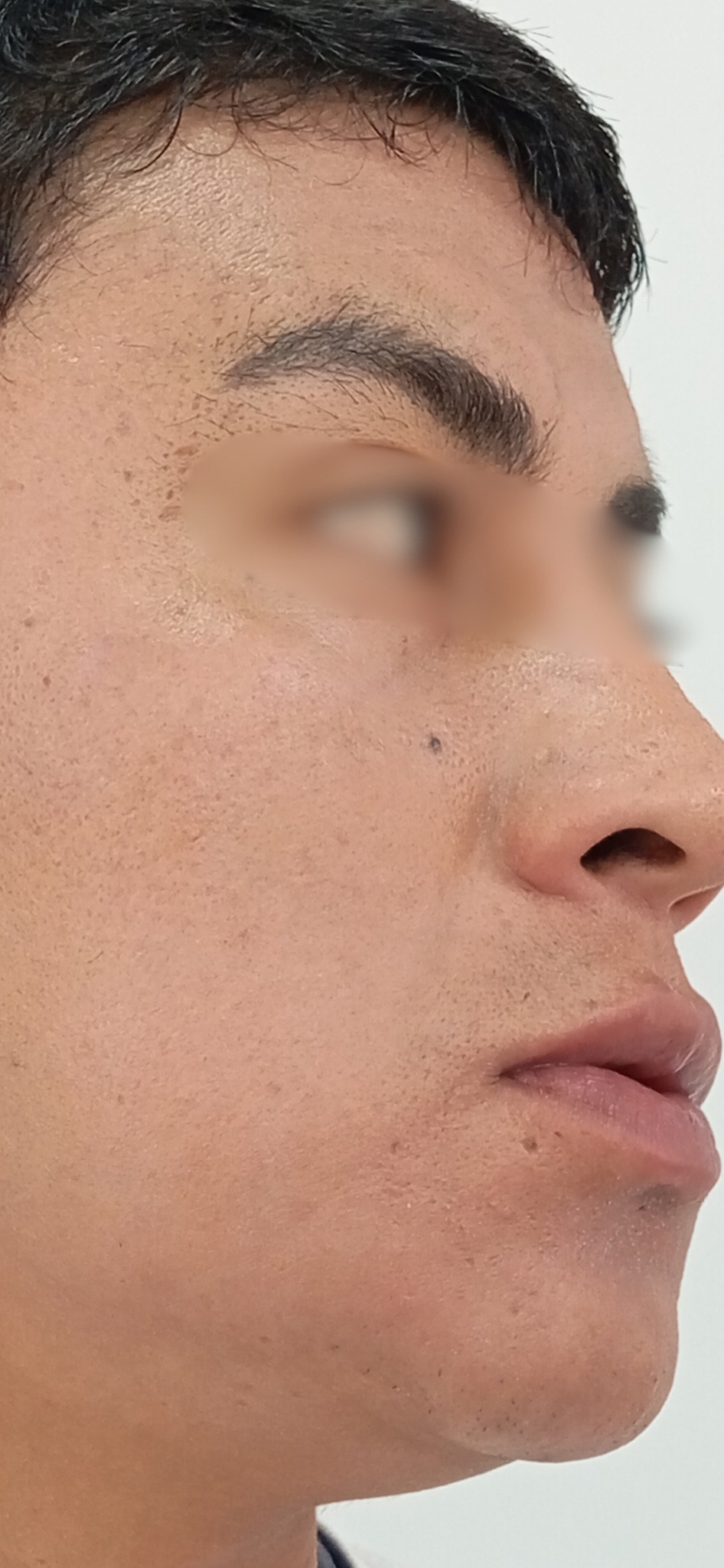 Después del tratamiento Láser CO2