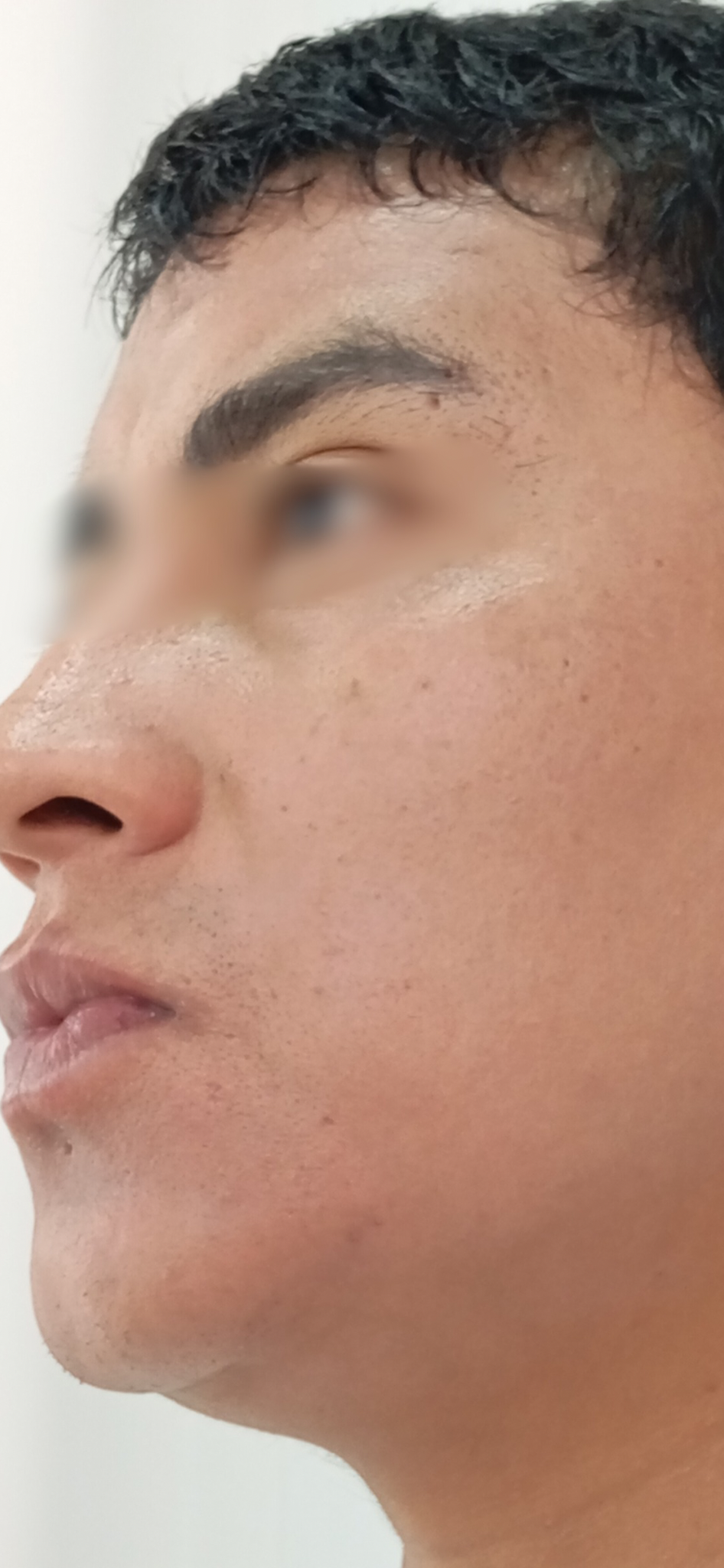 Después del tratamiento Láser CO2