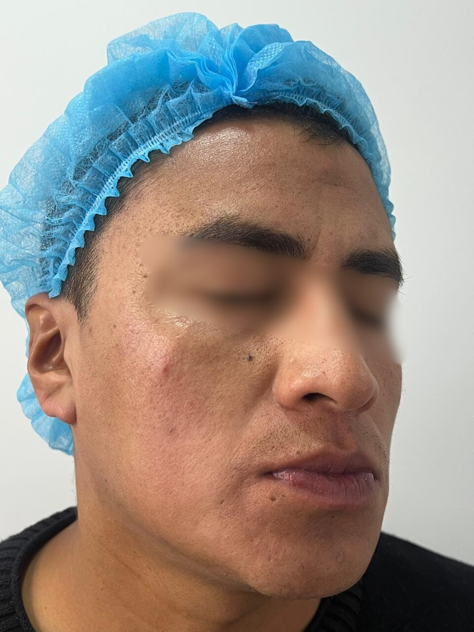 Antes del tratamiento Láser CO2