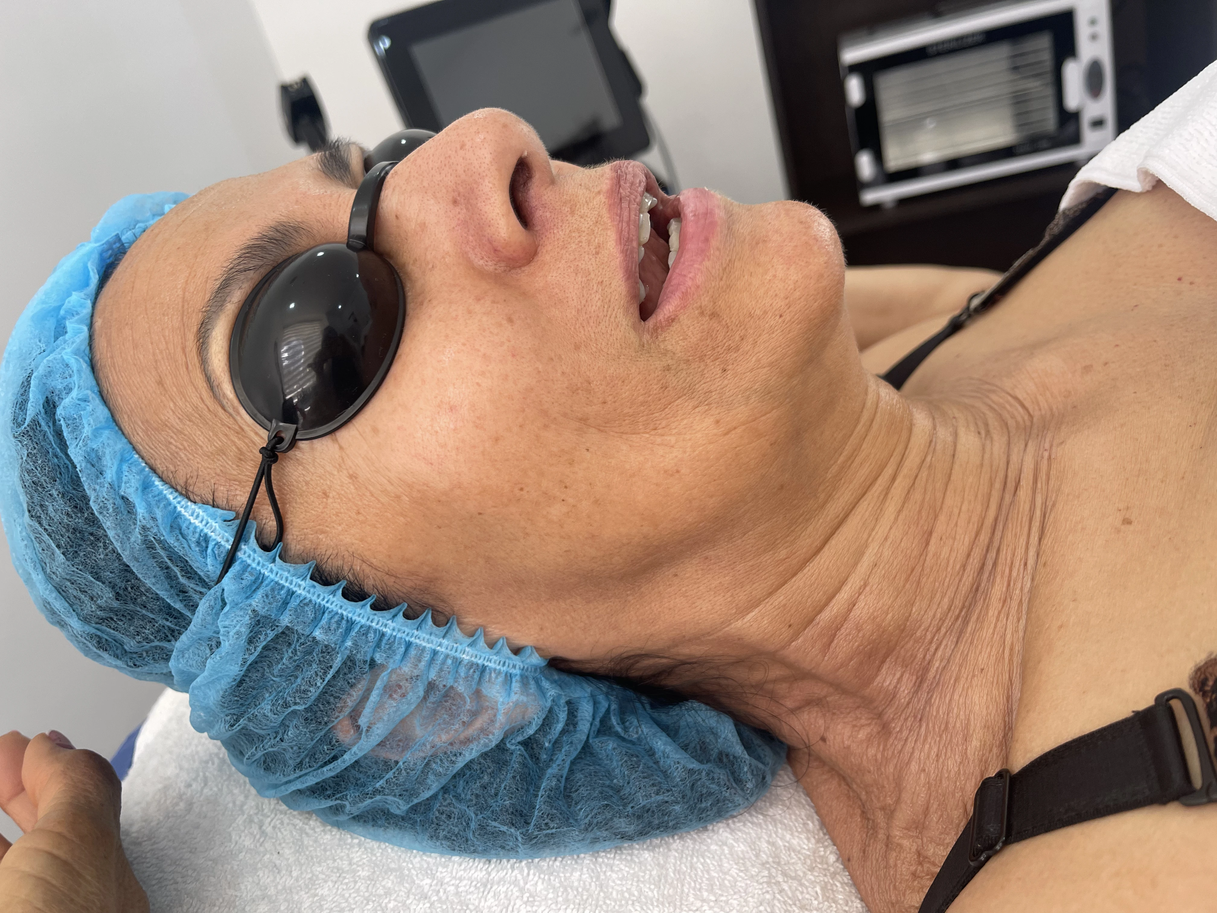 Antes del tratamiento Morpheus Facial