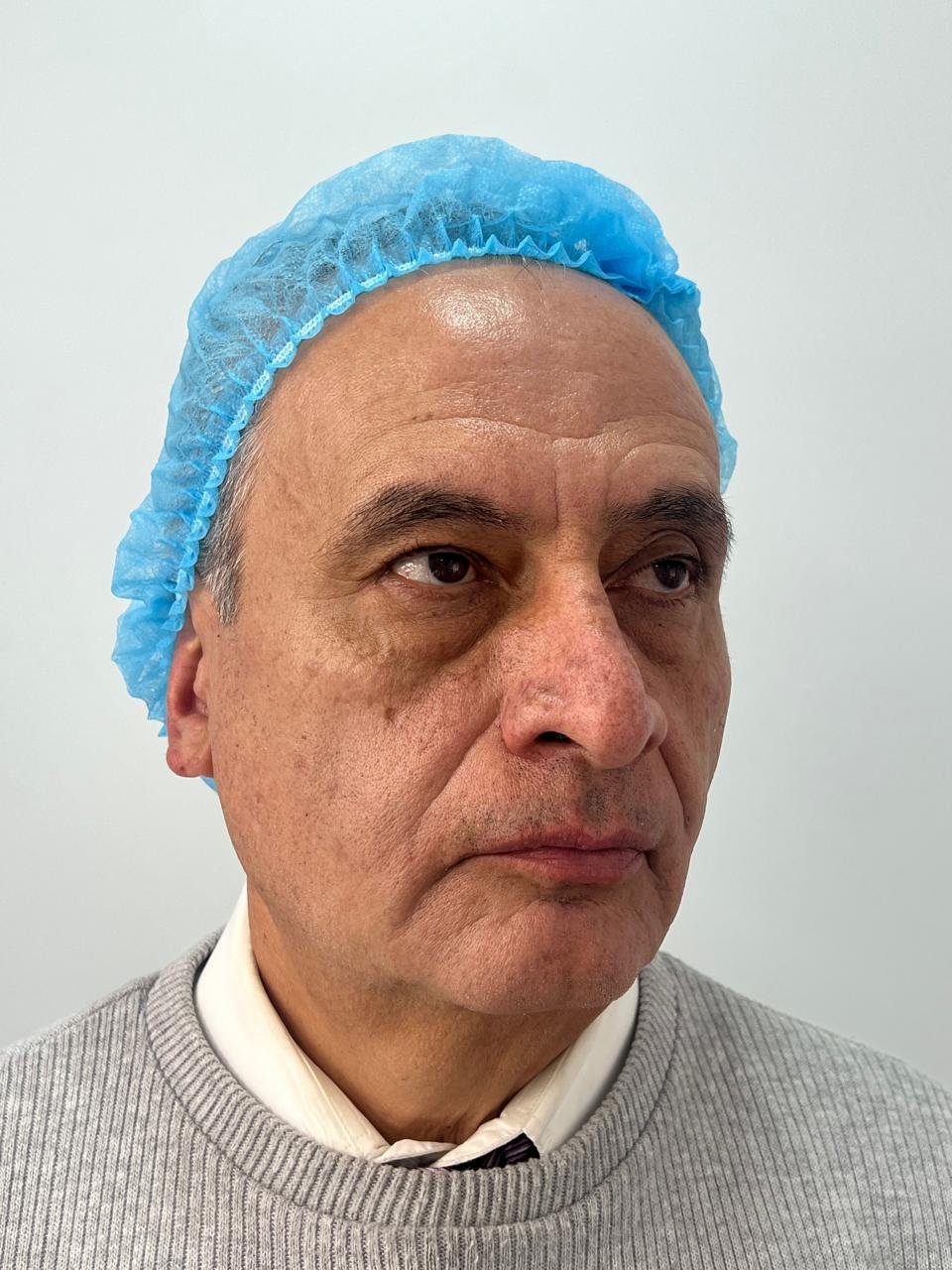 Después del tratamiento Pico Láser