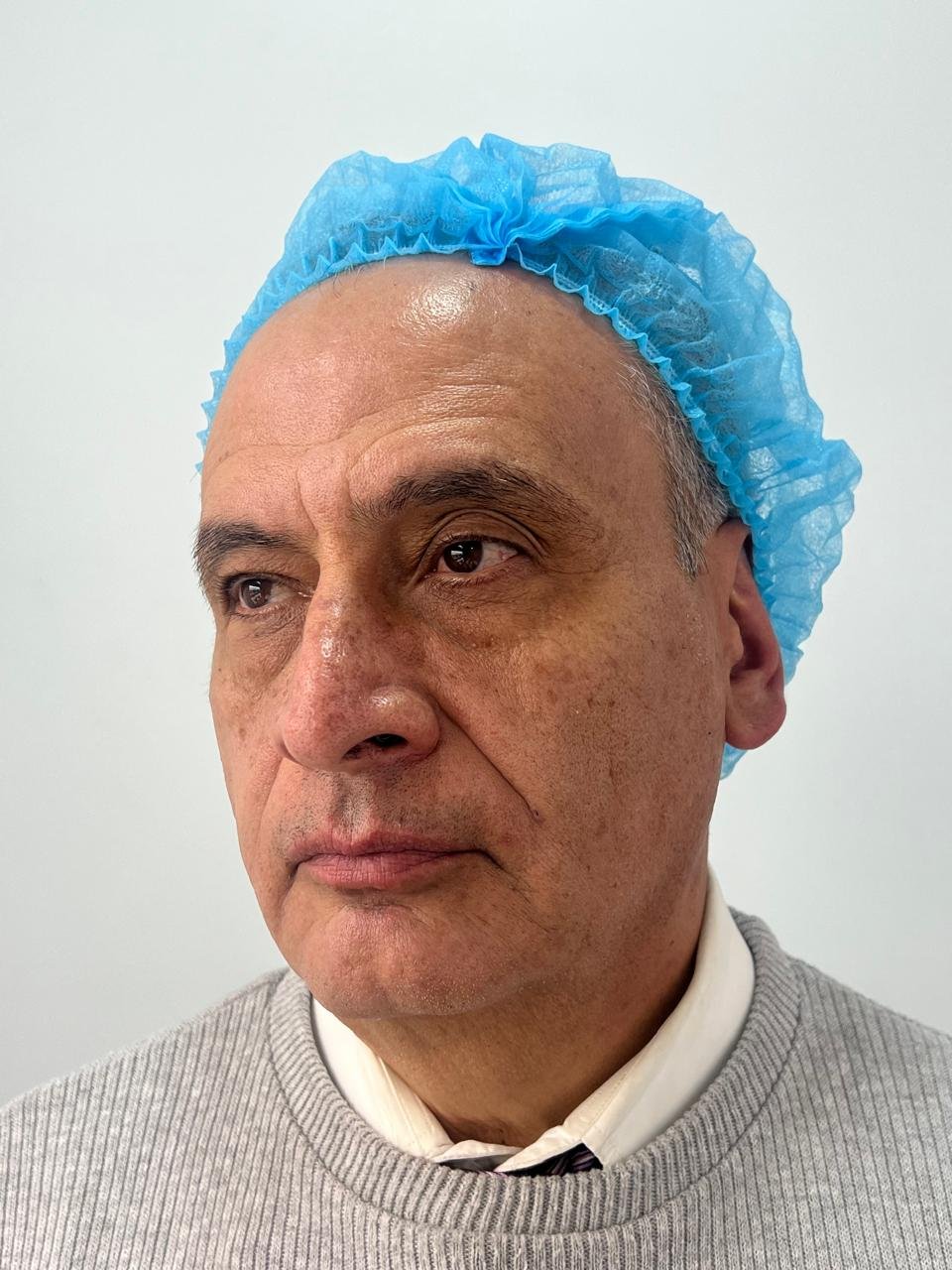 Después del tratamiento Pico Láser