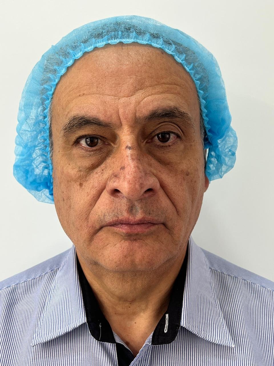 Antes del tratamiento Pico Láser