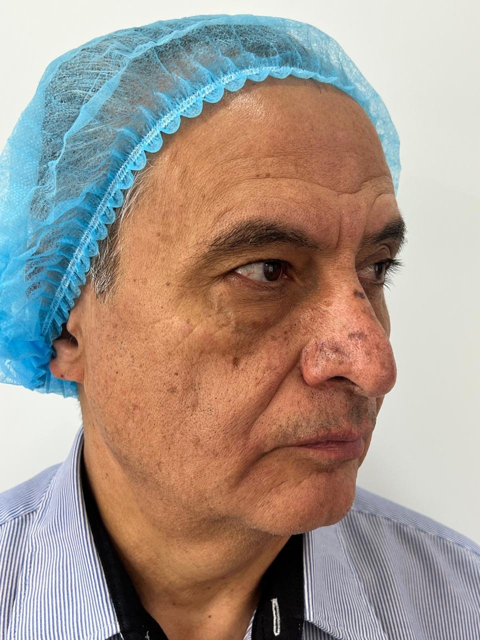 Antes del tratamiento Pico Láser