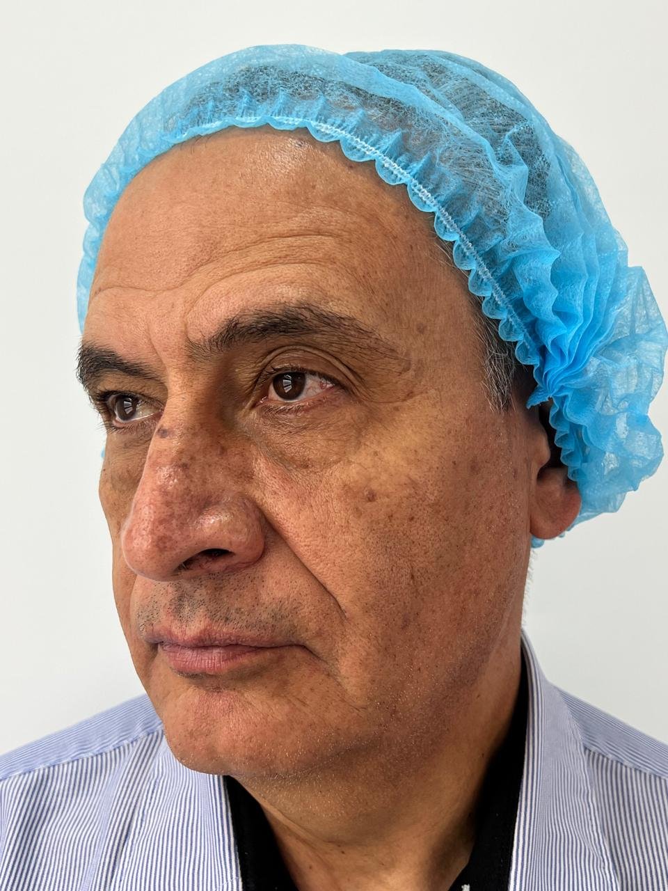 Antes del tratamiento Pico Láser