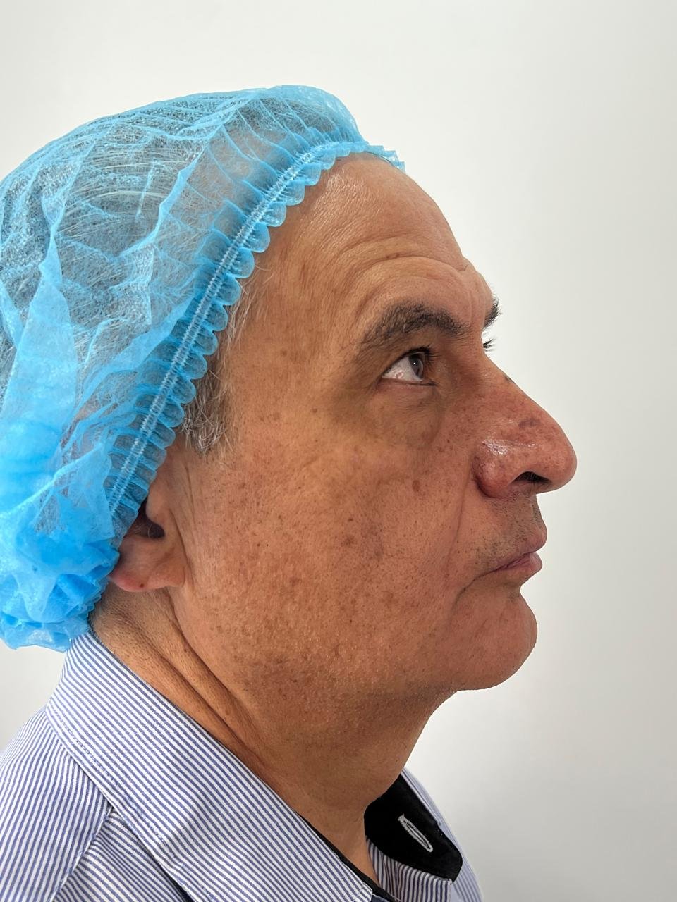 Antes del tratamiento Pico Láser